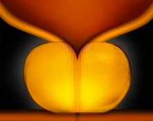  Próstata aumentada bloqueando a ilustração da uretra